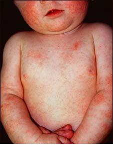 Dermatita atopica la copil