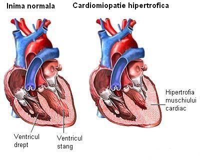Cardiomiopatia hipertrofica