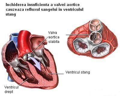 Insuficienta aortica (regurgitarile de valva aortica)