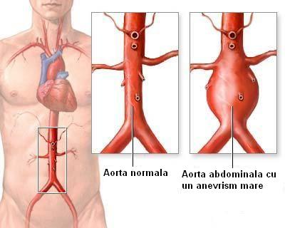 Anevrismul aortic (aorta anevrismala)