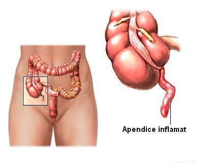 Apendicectomia - operatia de apendicita