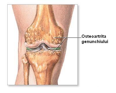 Gonartroza - osteoartrita genunchiului ⋆ Sanacas
