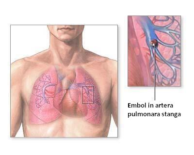Embolismul pulmonar