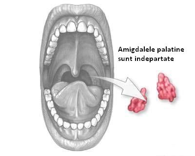 Amigdalita - inflamatia amigdalelor