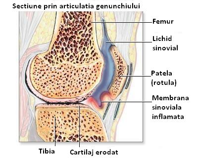 Artrita patelă