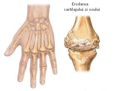 analize medicale pentru artrita