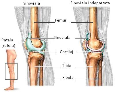 artrita cronica a genunchiului)