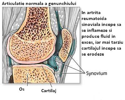 Artroza reumatoidă a genunchiului