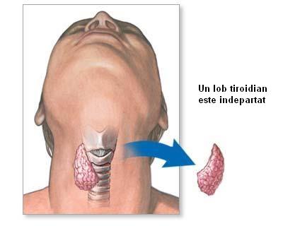 Tratamentul cancerului tiroidian