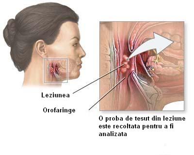 Efectele secundare al biopsiei de prostata sunt frecvente | prostatita.adonisfarm.ro