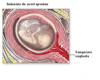 Avortul spontan - pierderea spontana a sarcinii