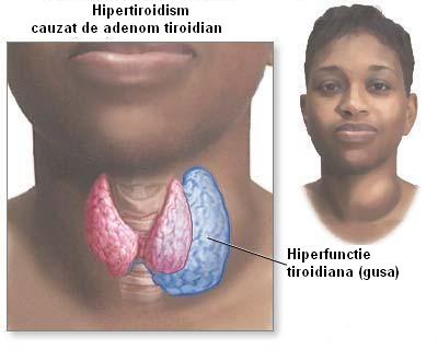 Hipertiroidismul