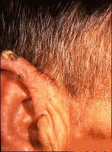 Poze Medicale Keratoza Seboreica