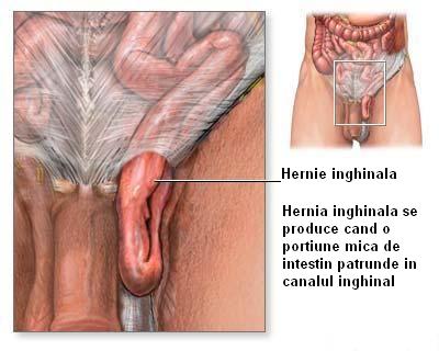 Hernie inghinala: simptome, tratament