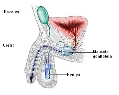 incontinență urinară la bărbații cu cauze de prostatită
