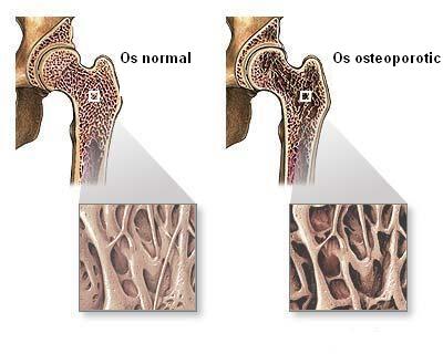 Tratamentul cu calciu pentru osteoporoza
