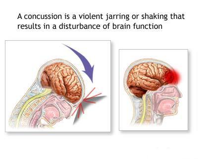 Leziunile traumatice craniocerebrale (Comotia cerebrala)