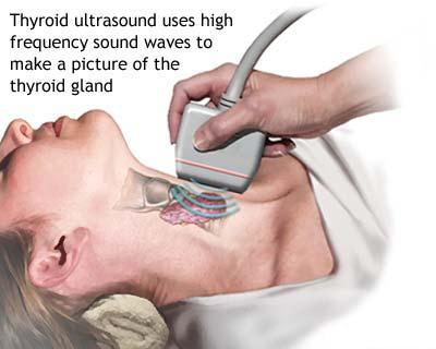 Nodulii tiroidieni