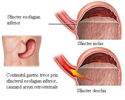 Arsurile gastrice, hernia hiatala si boala  de reflux gastroesofagian (GERD