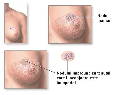 Nodul de regenerare prostata