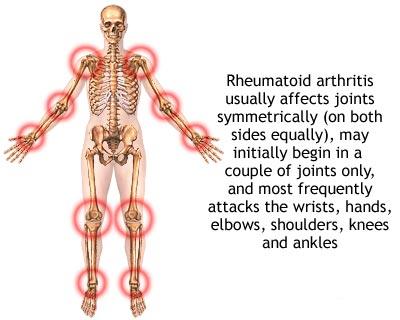 Artrita reumatoida – importanta exercitiului fizic