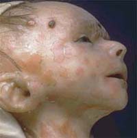 Sifilisul congenital - generalitati