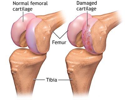 Recuperarea genunchiului după operația de menisc