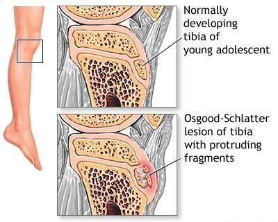 Boala articulației genunchiului lui Schlatter)