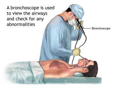 Bronhoscopia - explorarea vizuala a cailor respiratorii