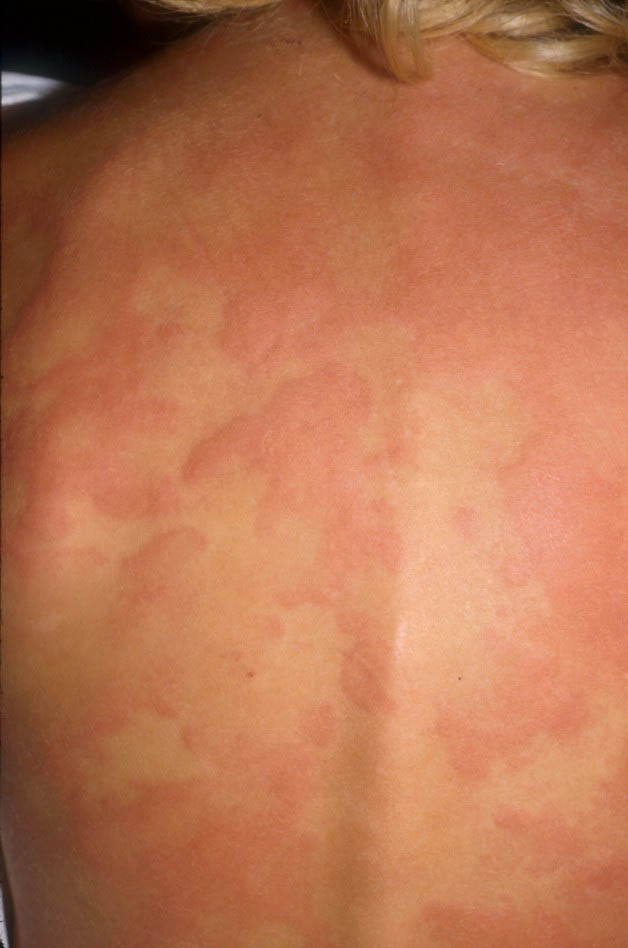 Bolile alergice la varstnici