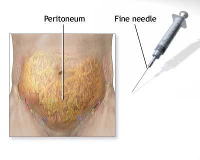 Peritonite acute difuze