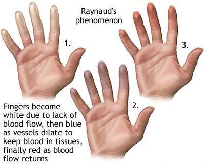 Sindromul durerii articulare a lui Raynaud, Boala Raynaud si fenomenul Raynaud