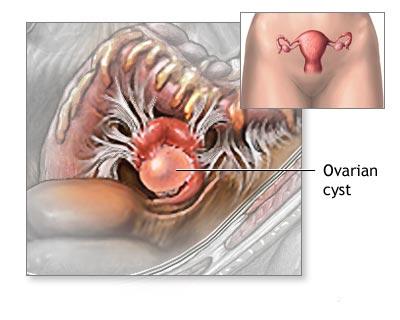 Chist ovarian functional