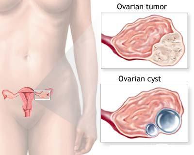 Totul despre chistul ovarian: Cauze, simptome si tratament corect | menopauza.bucovinart.ro