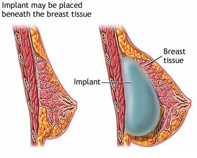 Operatia de marire a sanilor sau mamoplastia