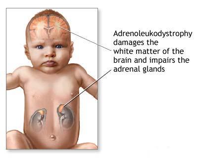 Adrenoleucodistrofie neonatala