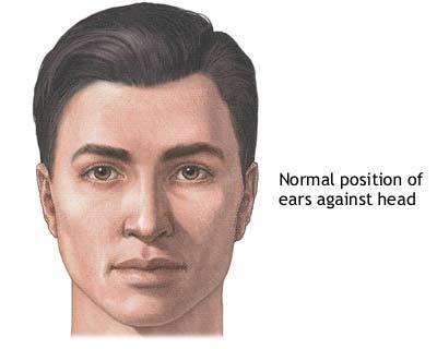 Remodelarea urechii (Otoplastia)