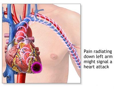 angina pectorală dureri articulare