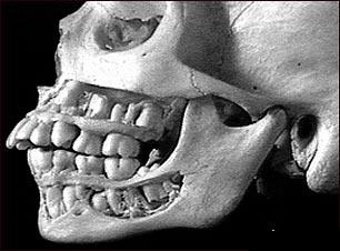 Craniu: malocluzie dentara