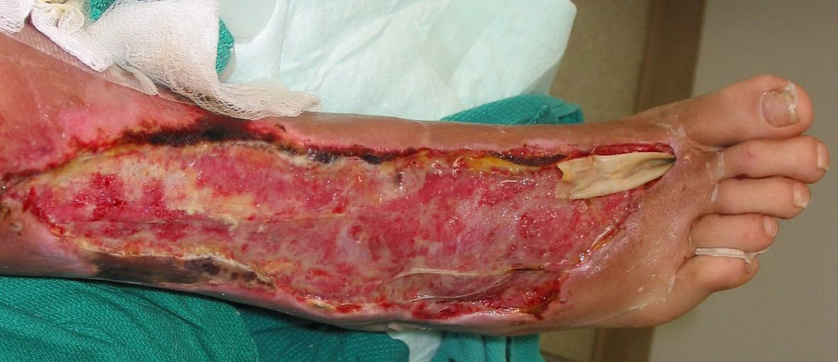 Fasceita necrozanta – infectia necrotizanta a fasciei si a tesutului subcutanat