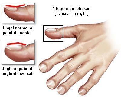Modificarile patologice ale unghiilor