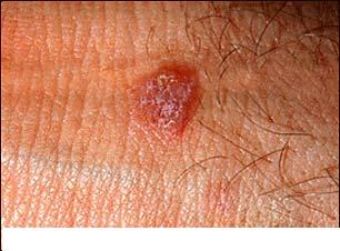 Psoriazis, lupus eritematos, lichen plan, pitiriazis rozat - afectiuni cu leziuni papuloscuamoase si papule nonconfluente