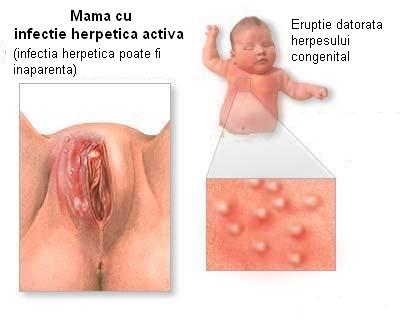 herpes genital photo. Images