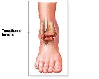tratament pentru exacerbarea artrozei genunchiului