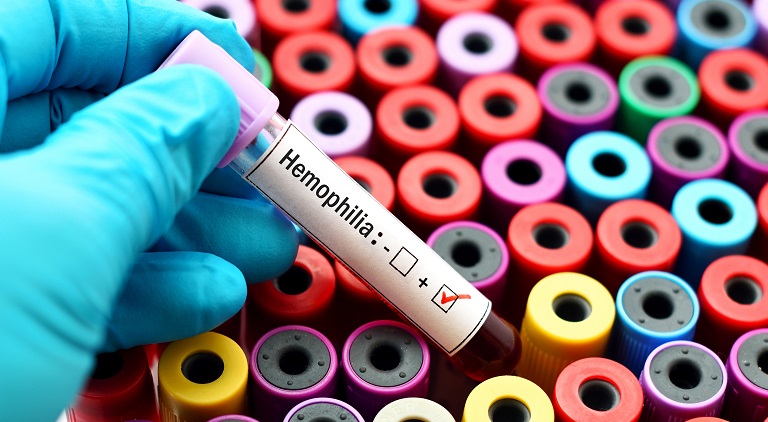 Semne si simptome in caz de hemofilie