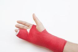tratamentul artrozei după o fractură de deget fractură a simptomelor articulației cotului și tratament