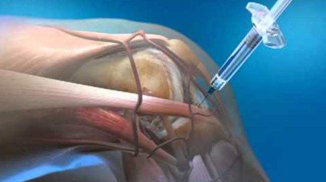 tratamentul artrozei internate a genunchiului trei injecții pentru durerile articulare