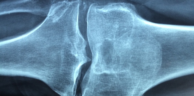 cum se poate vindeca artrita articulațiilor