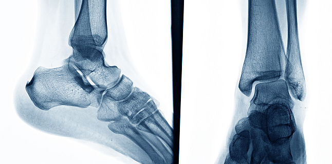 dureri de genunchi din articulația șoldului