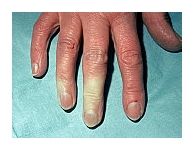 Reumatologia si bolile reumatice - Sindromul durerii articulare a lui Raynaud